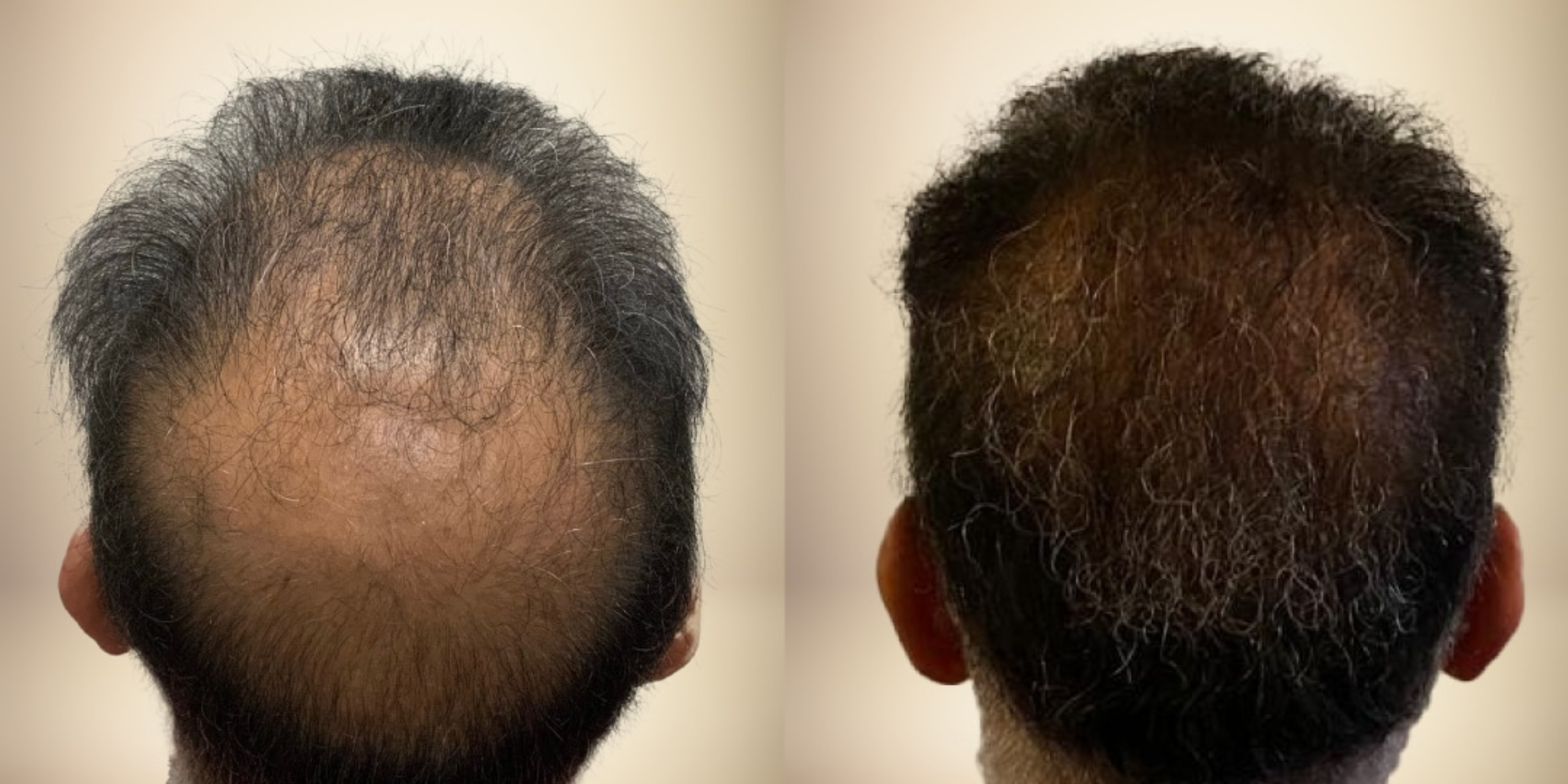 Before and After 2